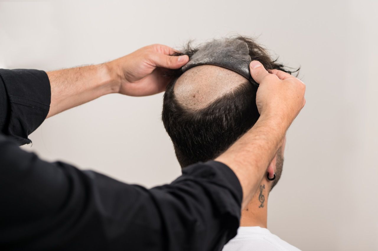 La Importancia del Crecimiento del Pelo en los Laterales al Usar Prótesis Capilares - Pro Hair