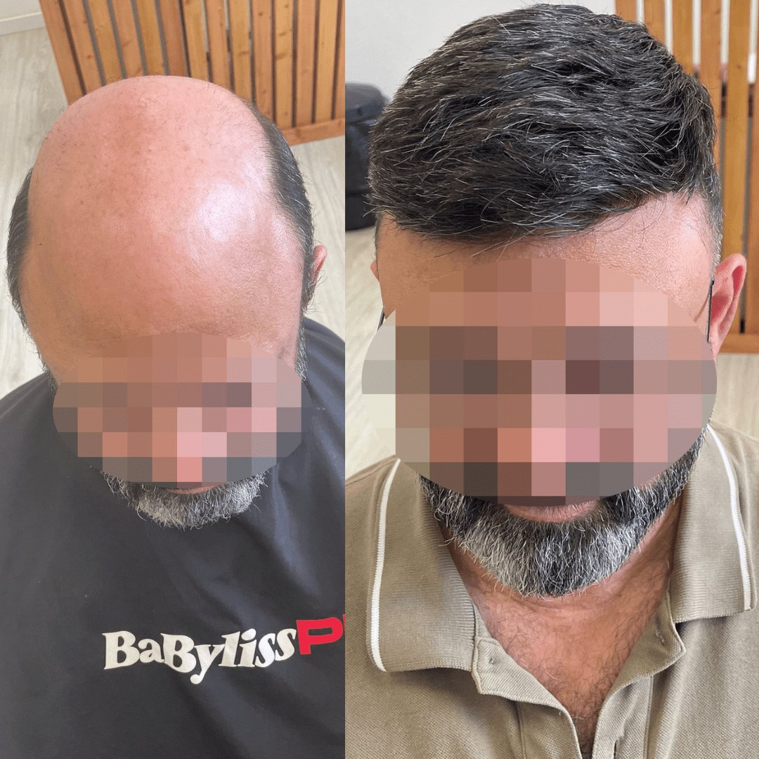 Mitigando Preocupaciones y Superando Desafíos al Usar Prótesis Capilares - Pro Hair